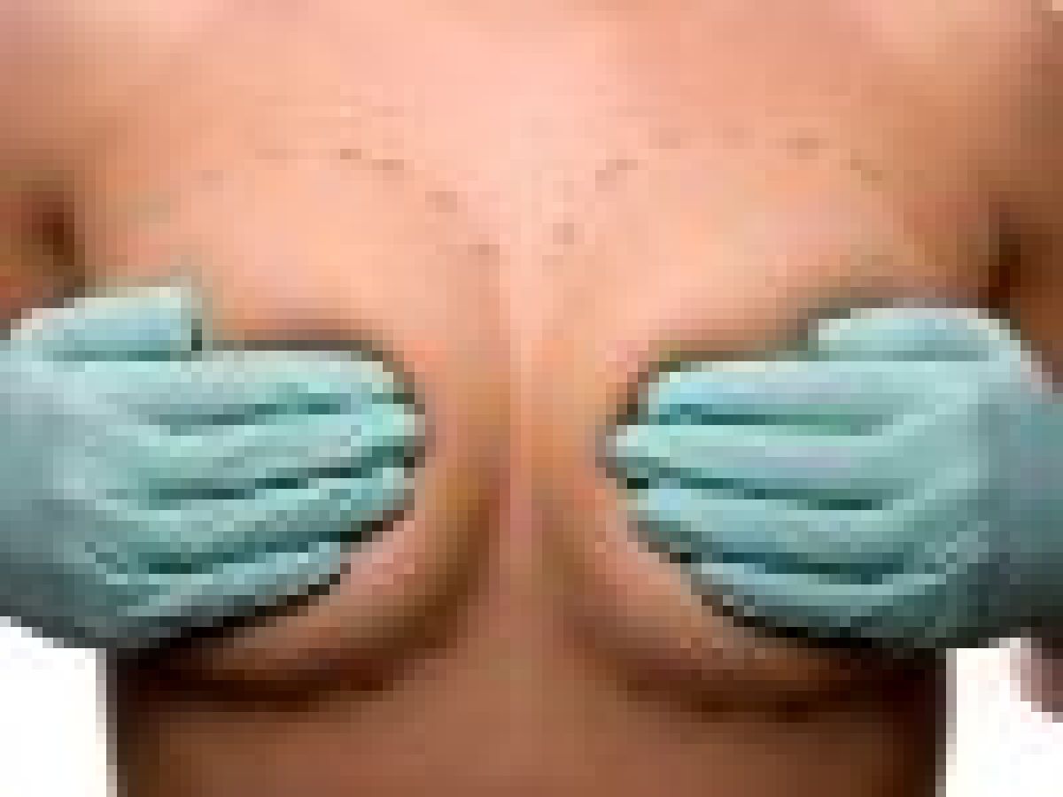 breast implants