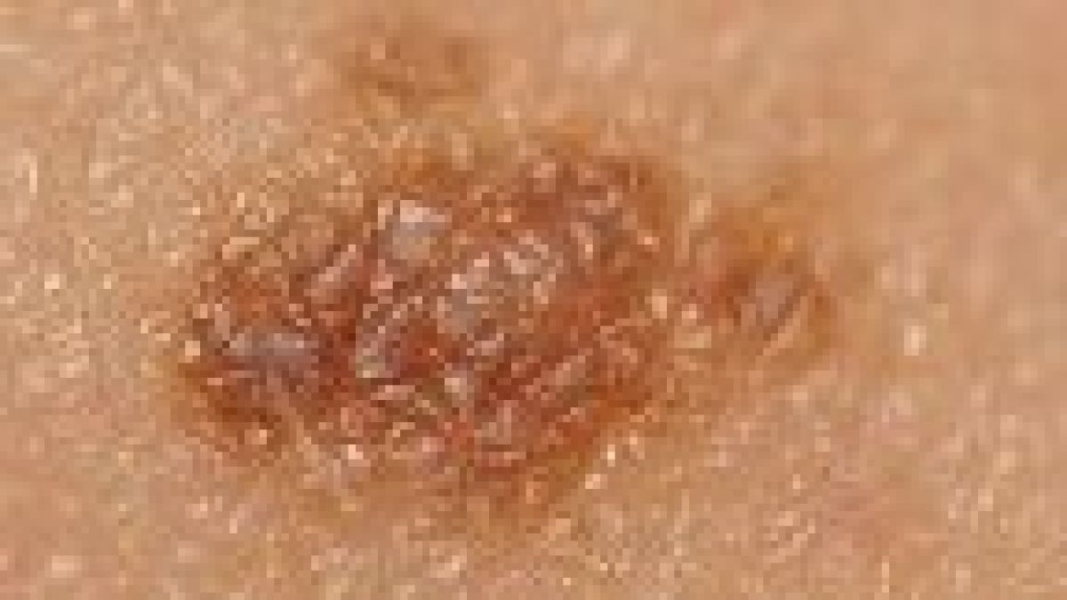 melanoma