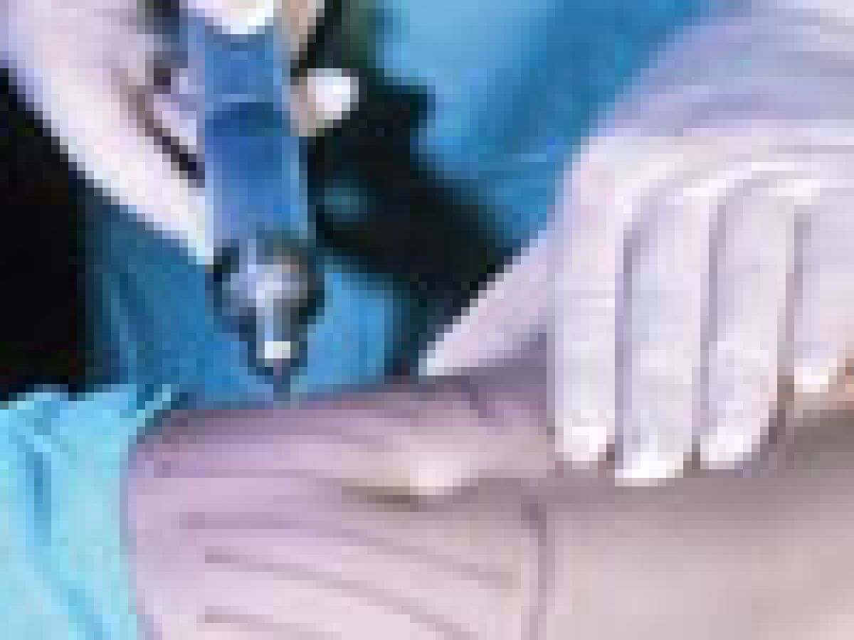 екстракција