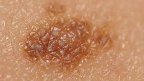 melanoma